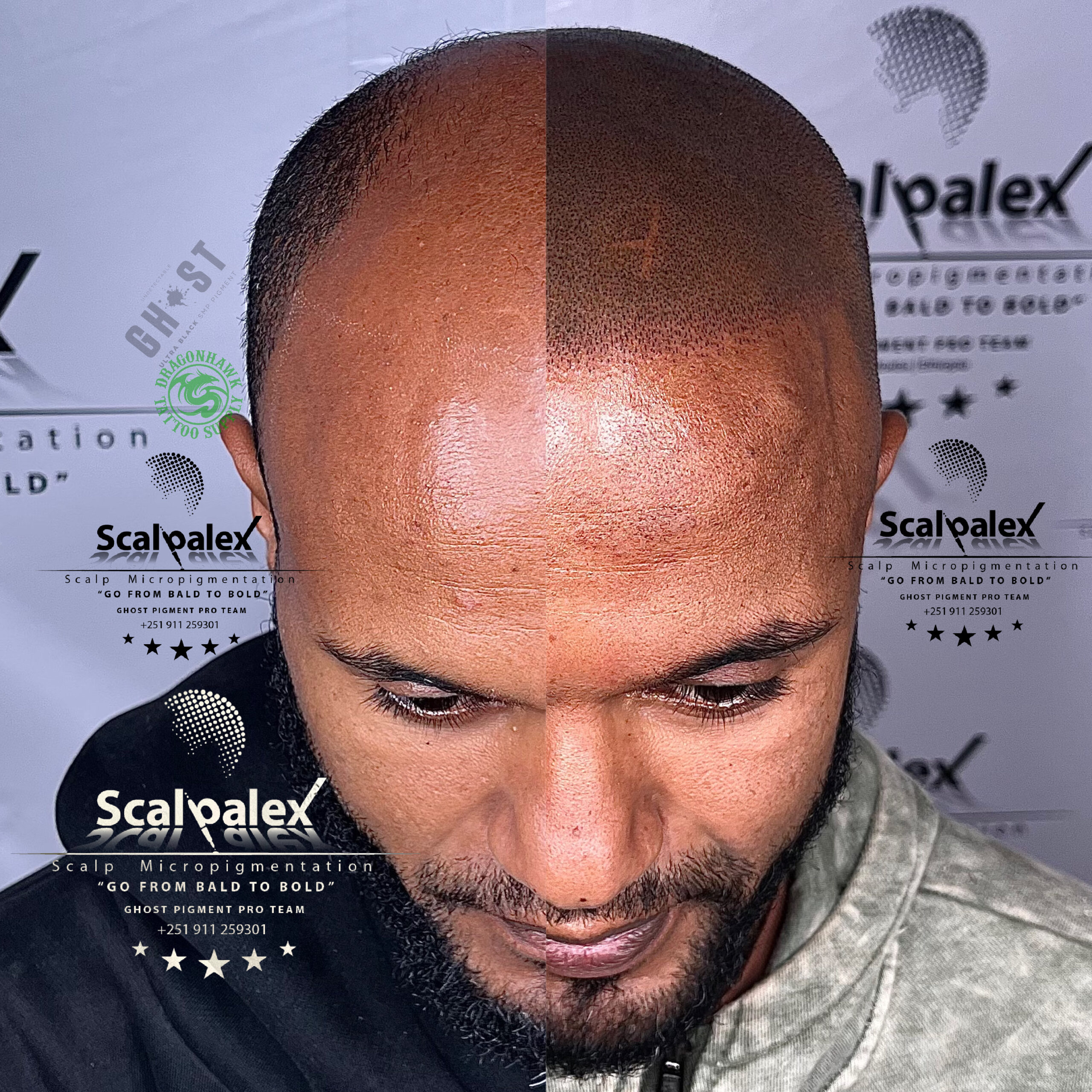 Scalp Micropigmentation