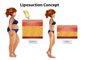 Emsculpt Neo vs liposuction